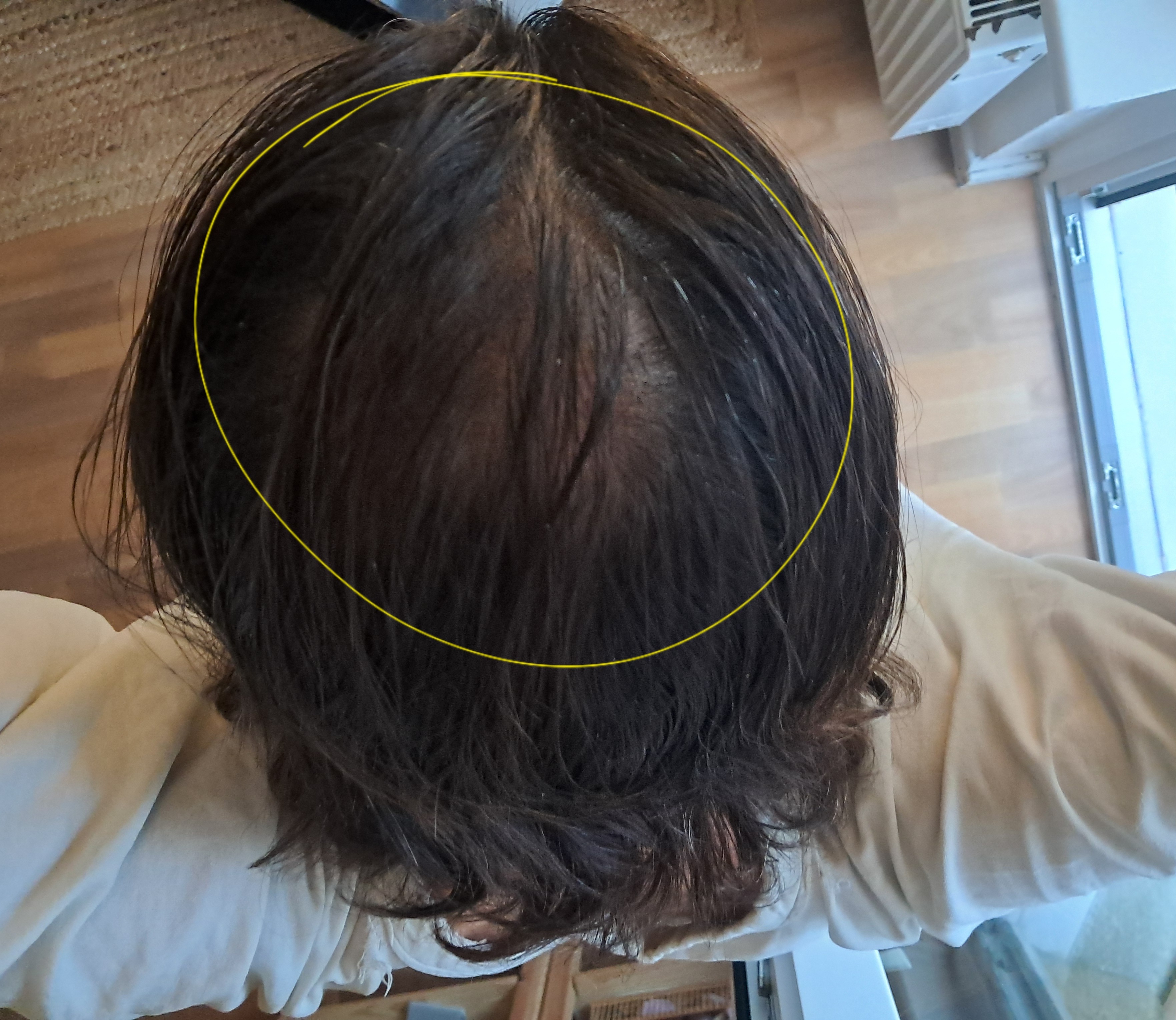 Glatzenbildung am Hinterkopf heilen