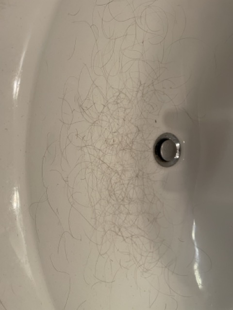 My hair loss