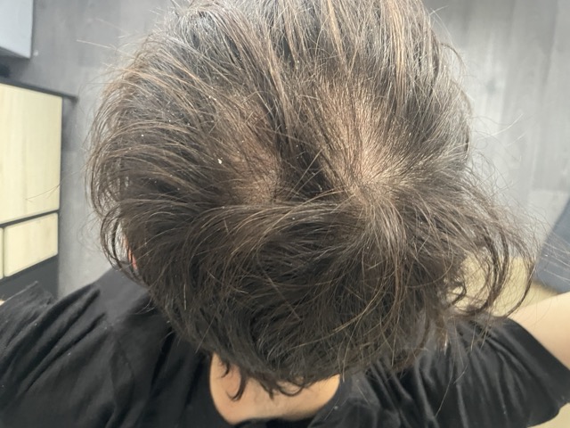 Minoxidil - Hair Before