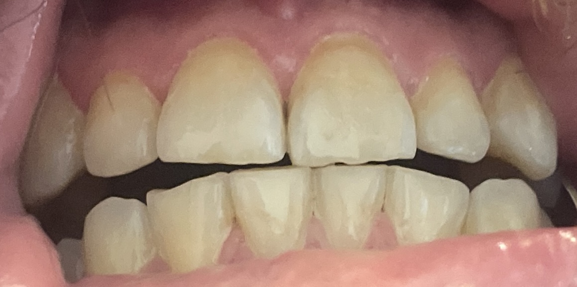 Zahnabbild, wenn man nicht Zähne putzt